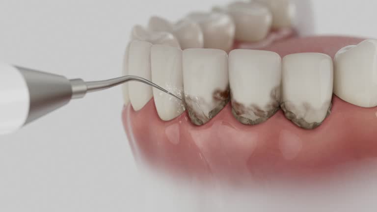 Trusted Wisdom Tooth Removal service in Plymouth, MN - Dentist Open Now